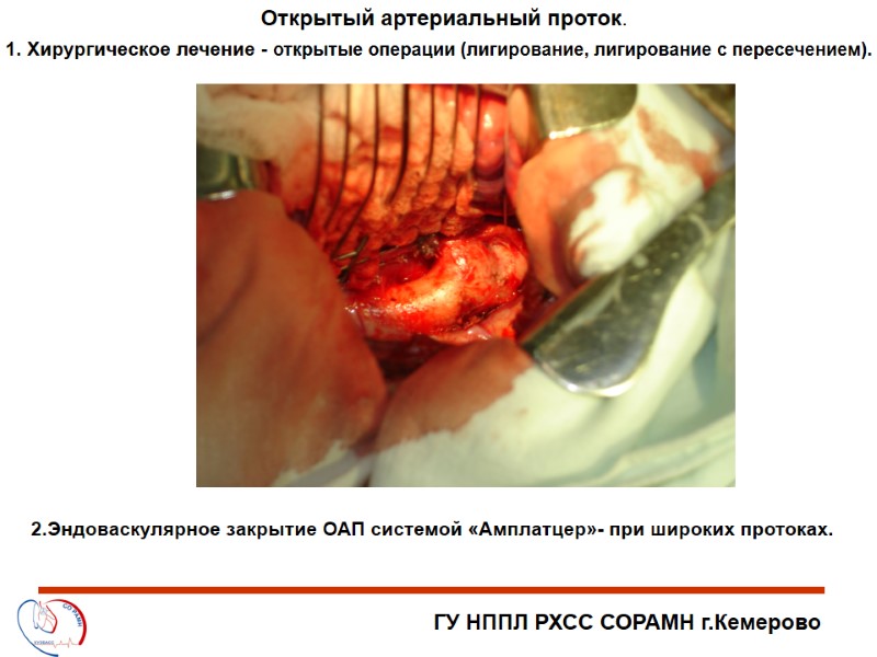 ГУ НППЛ РХСС СОРАМН г.Кемерово Открытый артериальный проток. 1. Хирургическое лечение - открытые операции